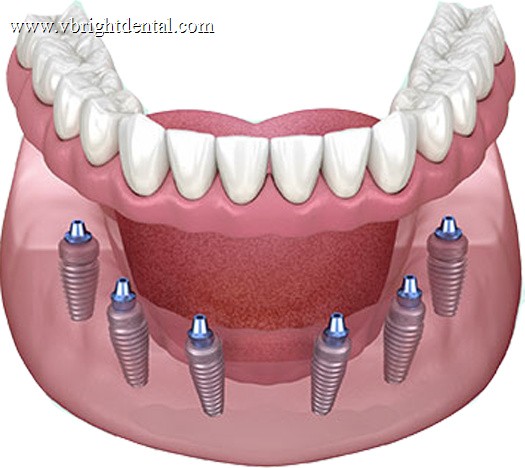 All-on-6 six-implant full-arch restoration