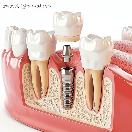 Dental implant structure: crown, abutment and implant