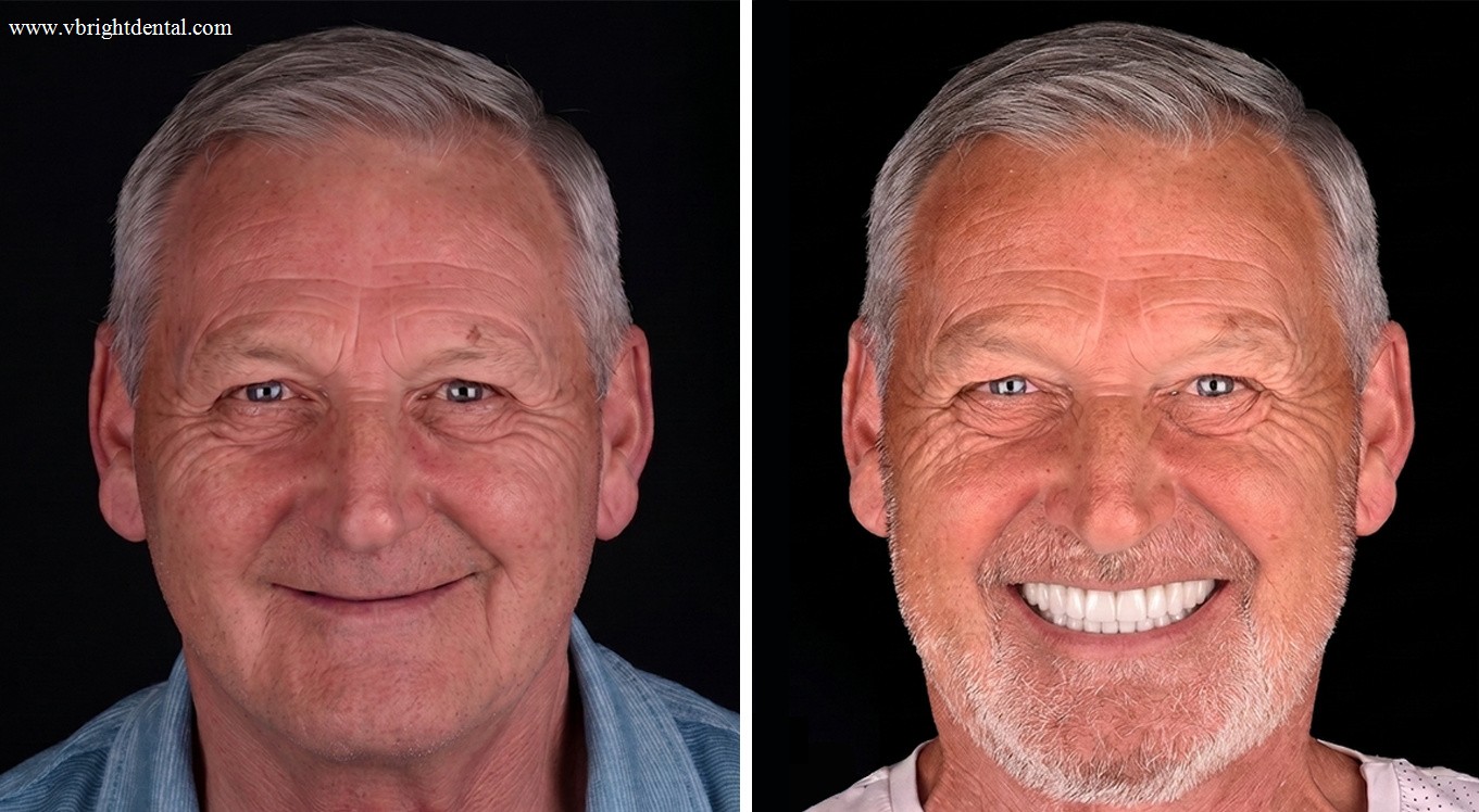 All-on-6 full arch before and after