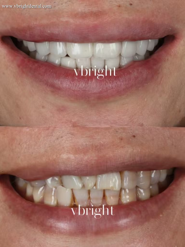 Hollywood smile veneers before and after