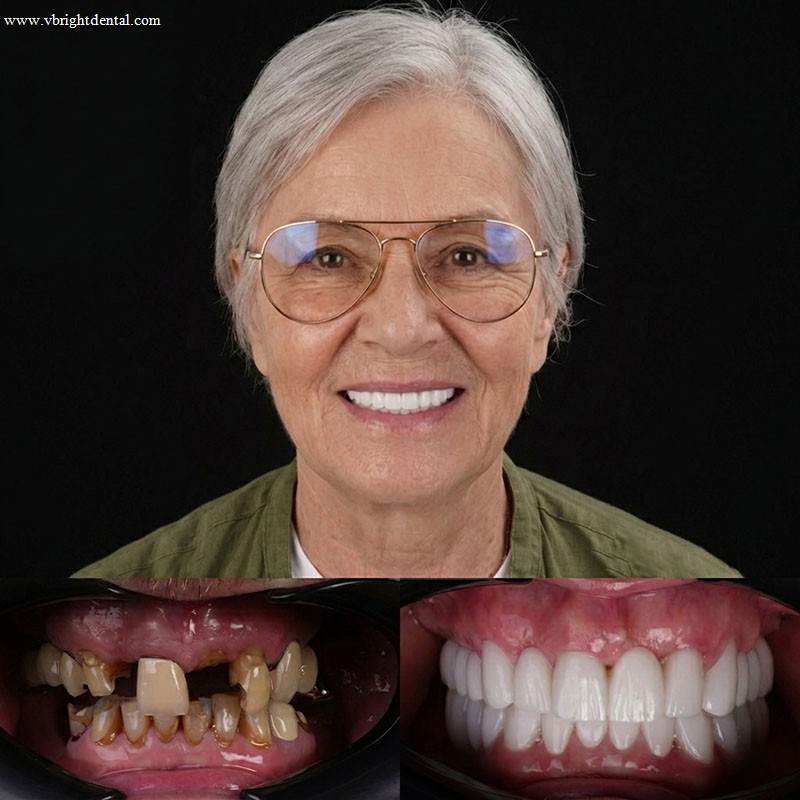 Dental implants comparison photo