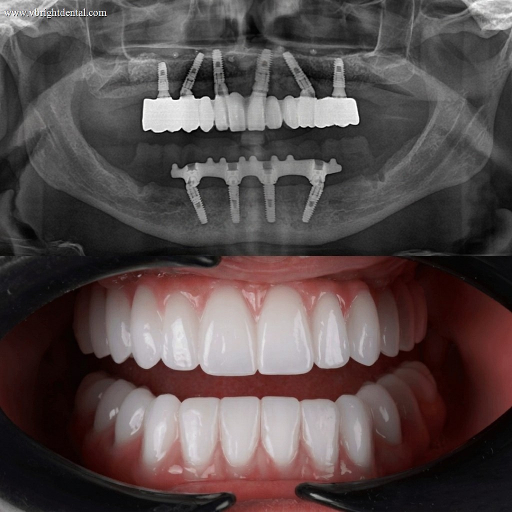 Teeth whitening comparison photo