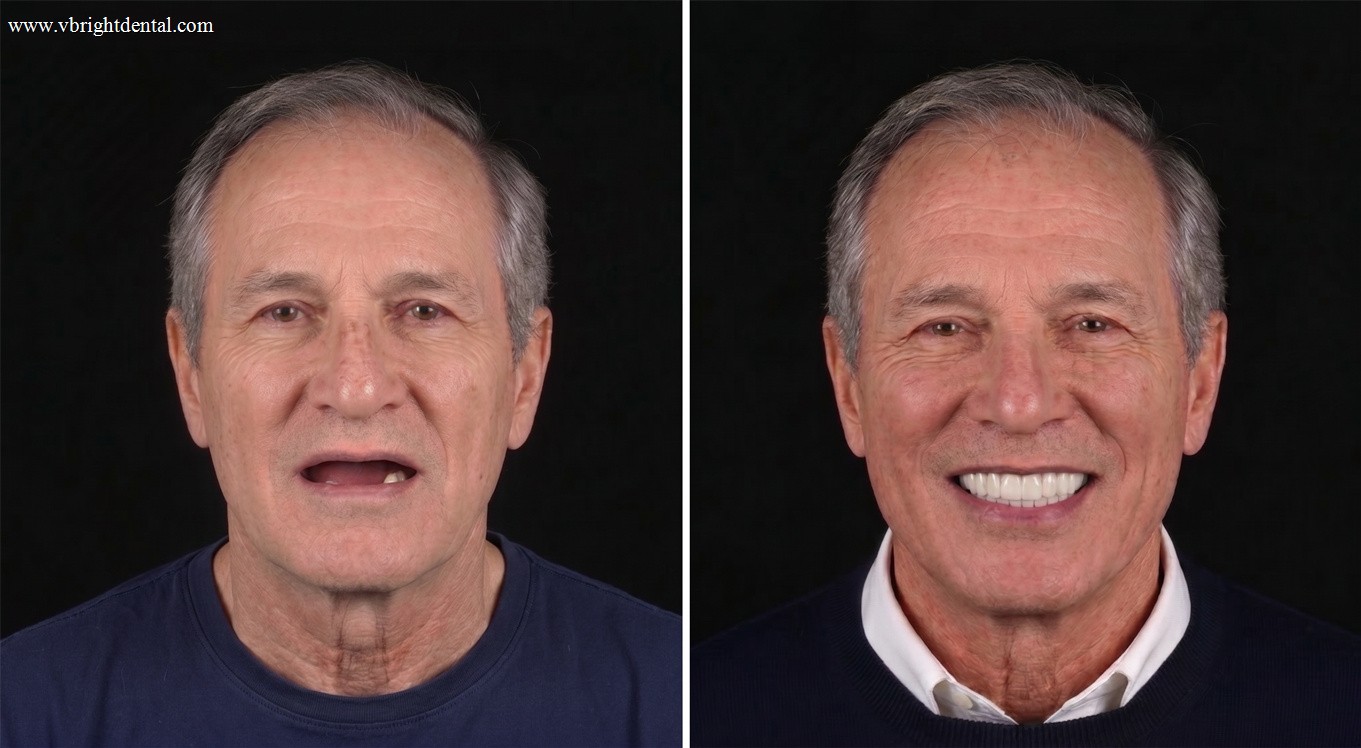 All-on-4 full arch before and after