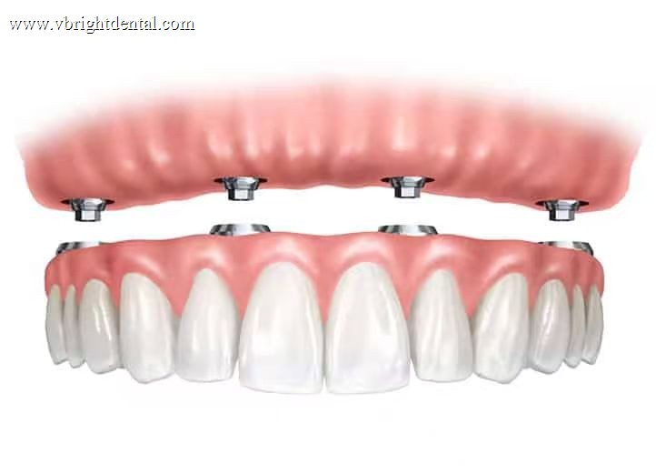 All-on-4 implant-supported full-arch bridge