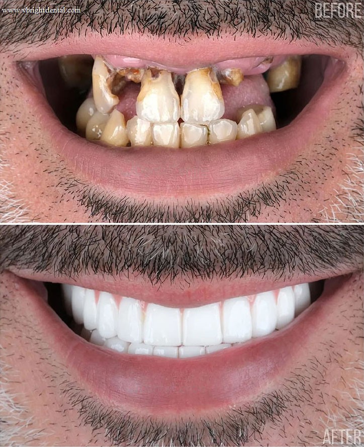 Zirconium crowns before and after