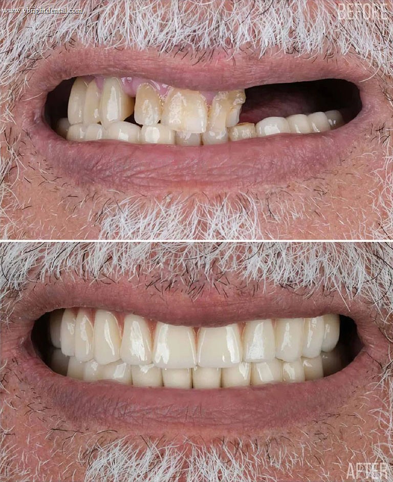 Dental implants before and after — full mouth restoration