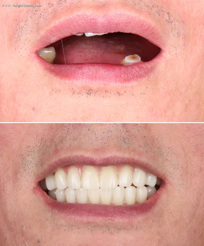 Dental implant before and after result